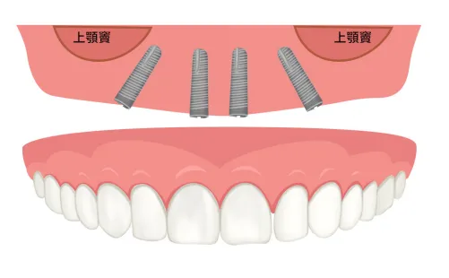 All on 4 全口重建，透過4支植體支撐半顎牙橋