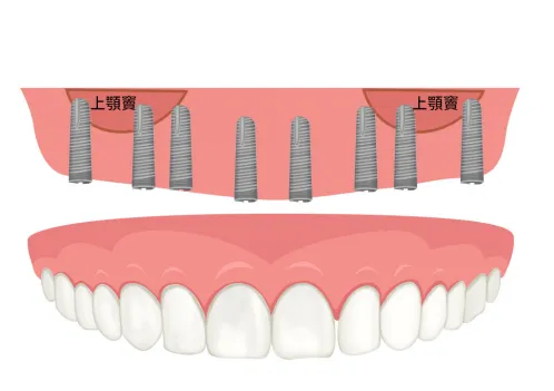 全口固定式假牙重建會植入較多的植體來分擔受力